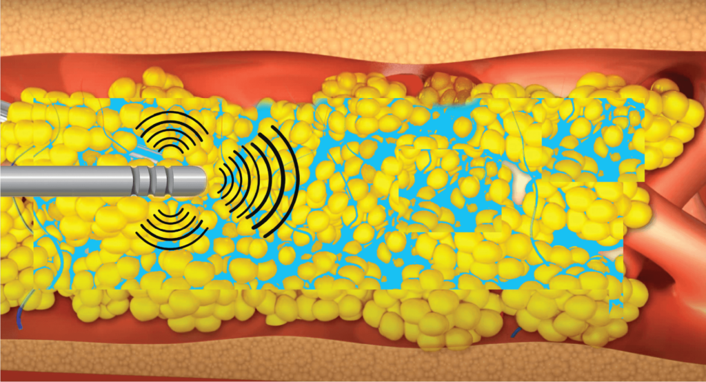 Lipovase - Ultrasound Assisted Liposuction
