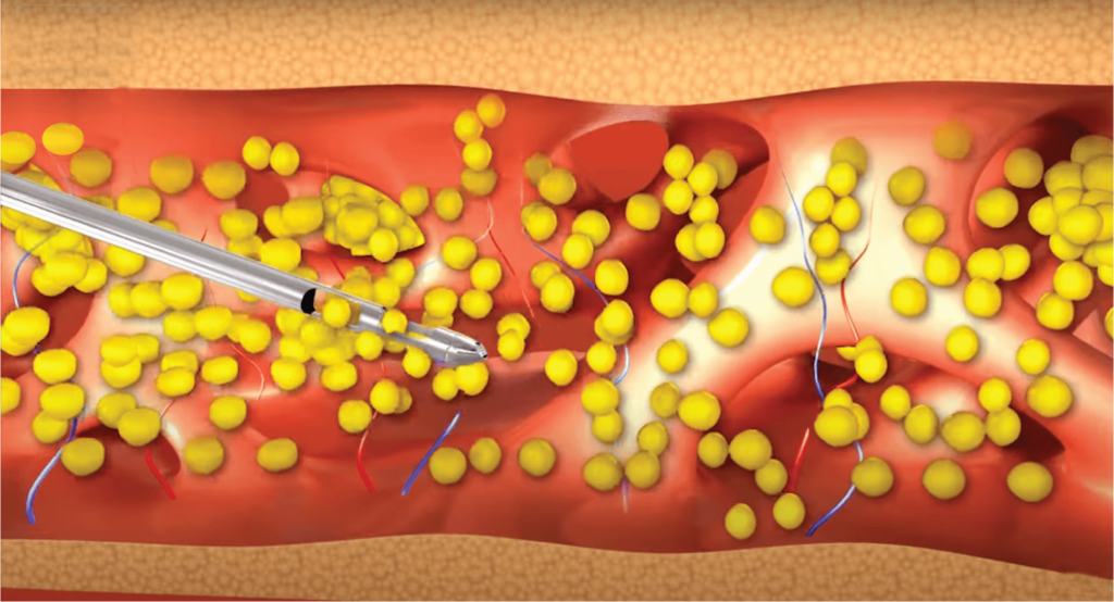Lipovase - Ultrasound Assisted Liposuction