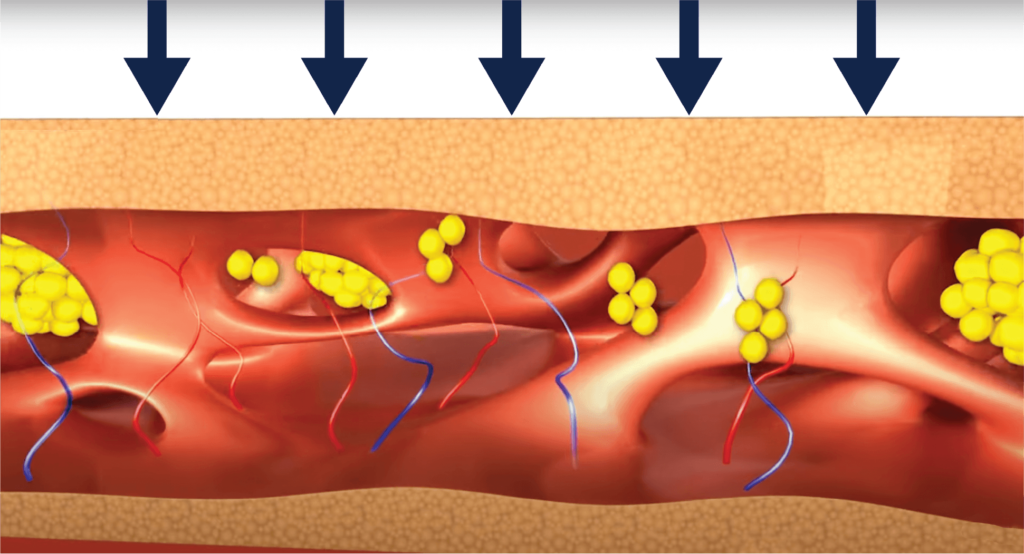 Lipovase - Ultrasound Assisted Liposuction