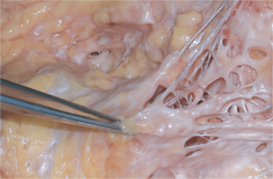 Lipovase - Ultrasound Assisted Liposuction